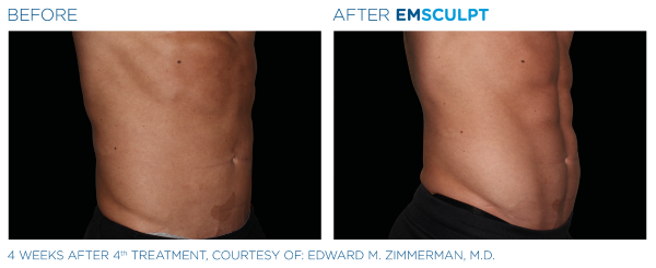 emsculpt-abdomen-man-side