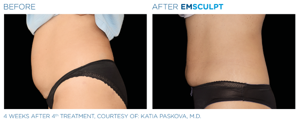 emsculpt-abdomen-woman-side