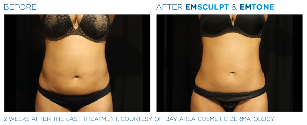 emsculpt-abdomen-woman
