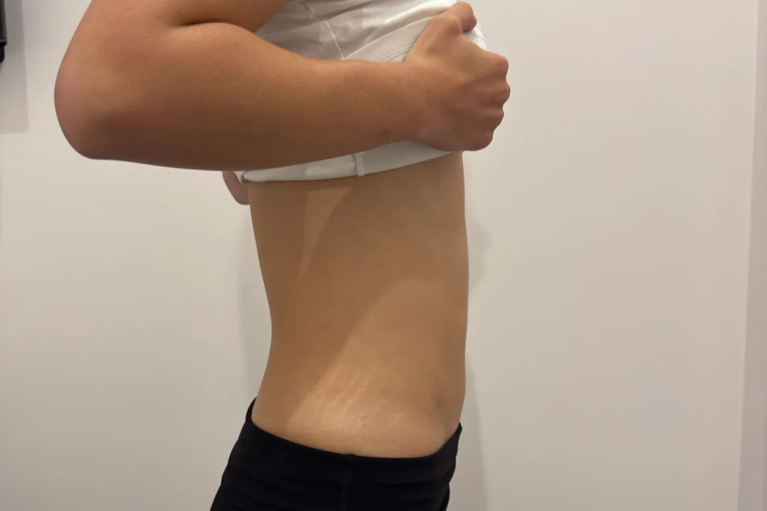 Nonsurgical Fat Reduction Canberra