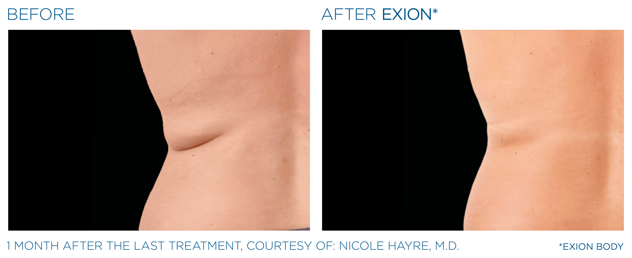 Exion-before and after back