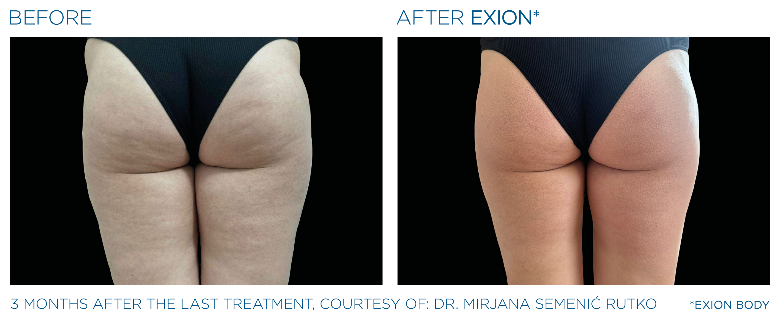 Exion-before and after buttocks