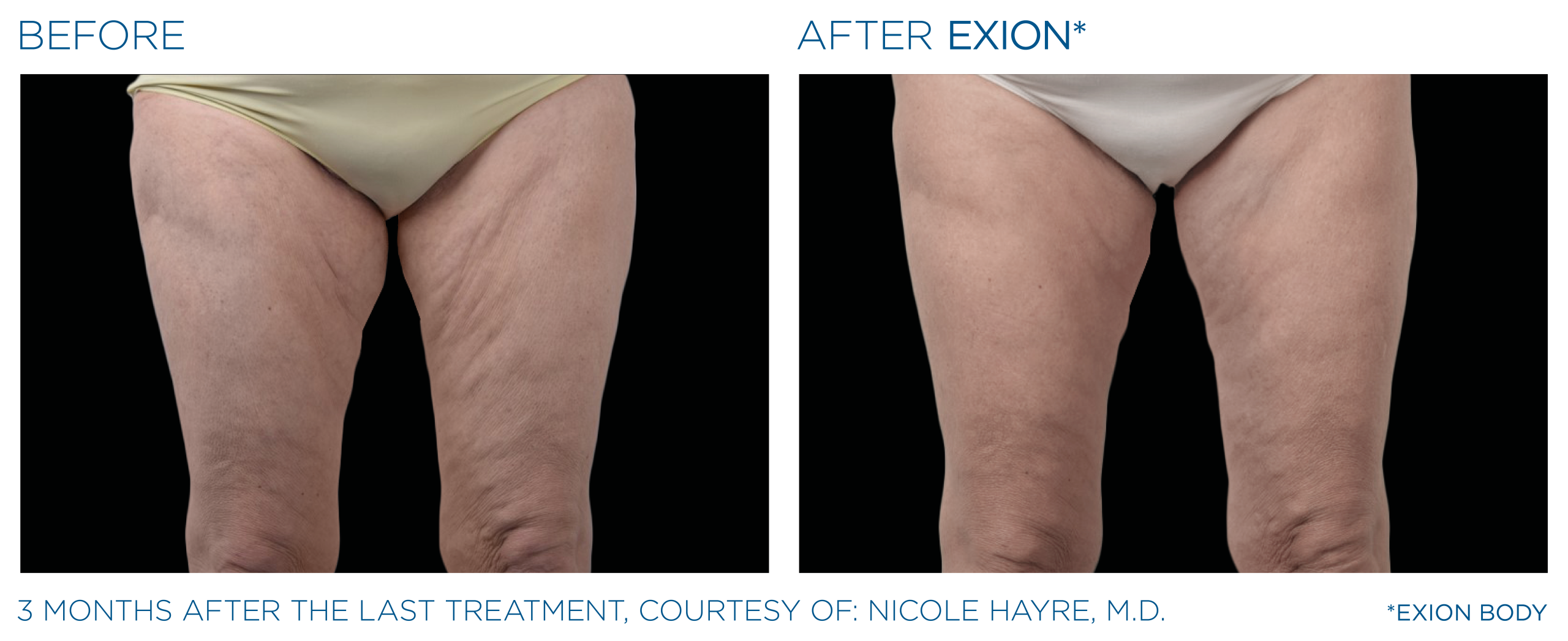 Exion-before and after-thighs