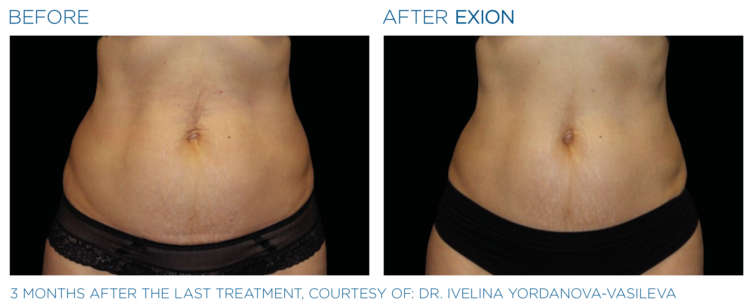 Exion before and after abdomen female