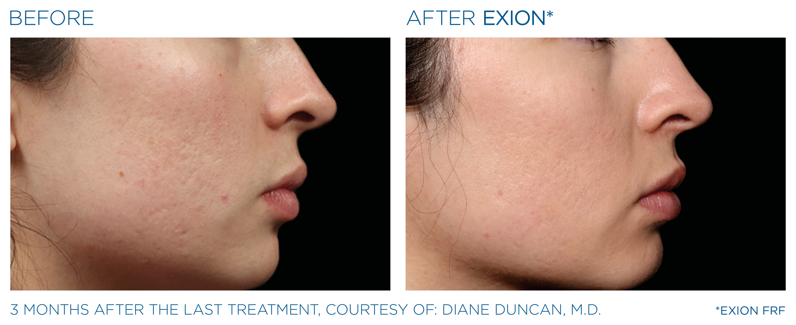 Exion before and after face side