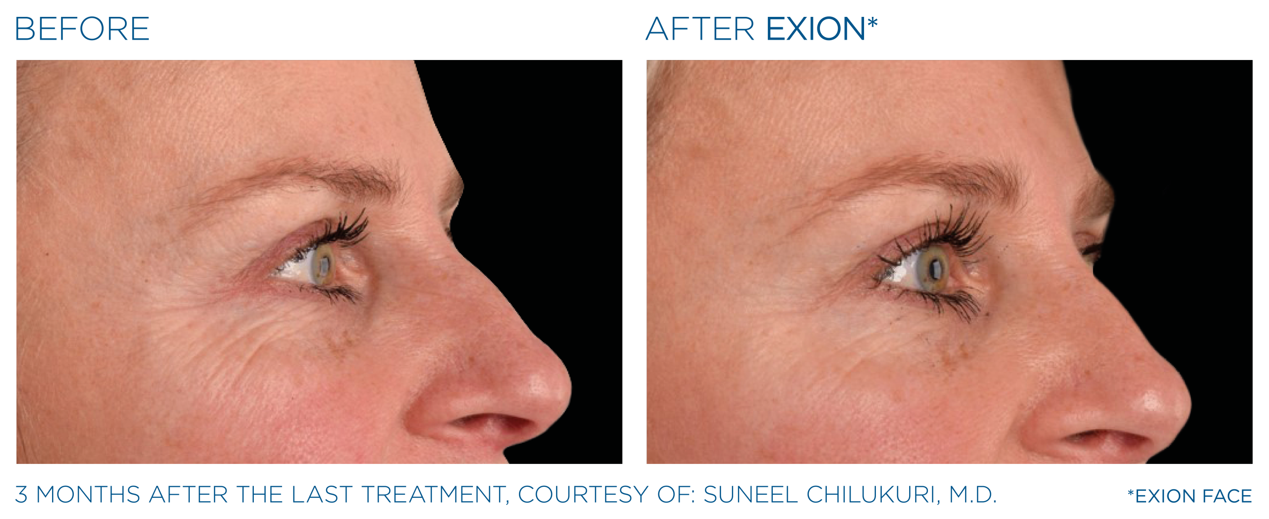 Exion before and after eyes female side