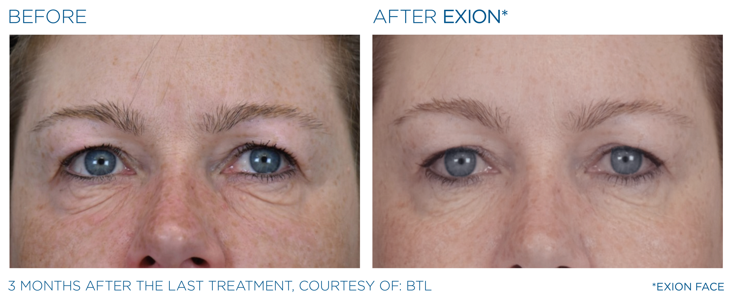Exion before and after eyes female
