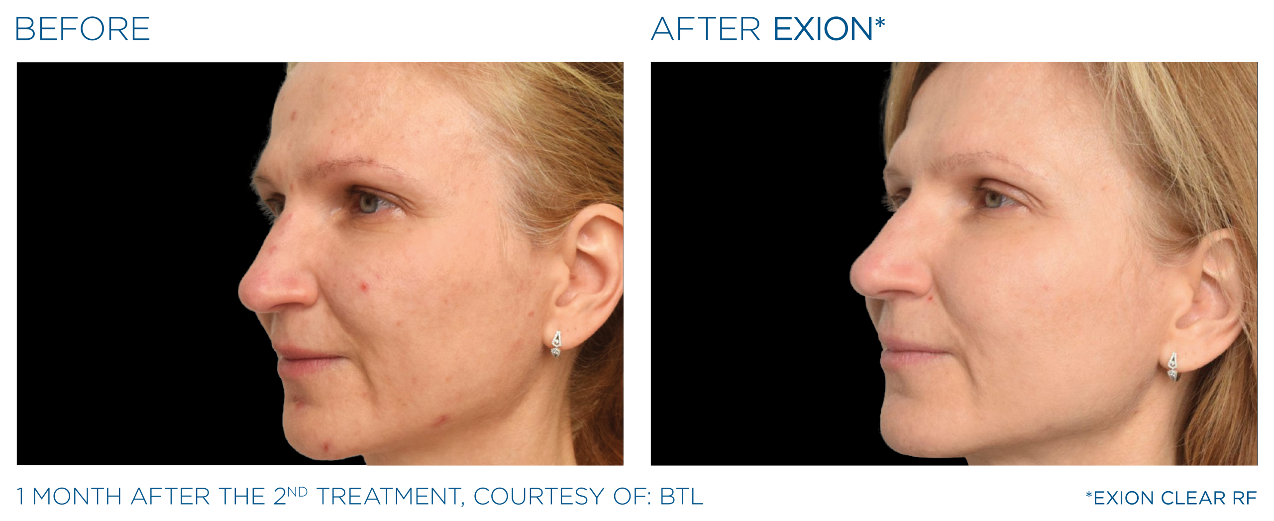 Exion before and after face