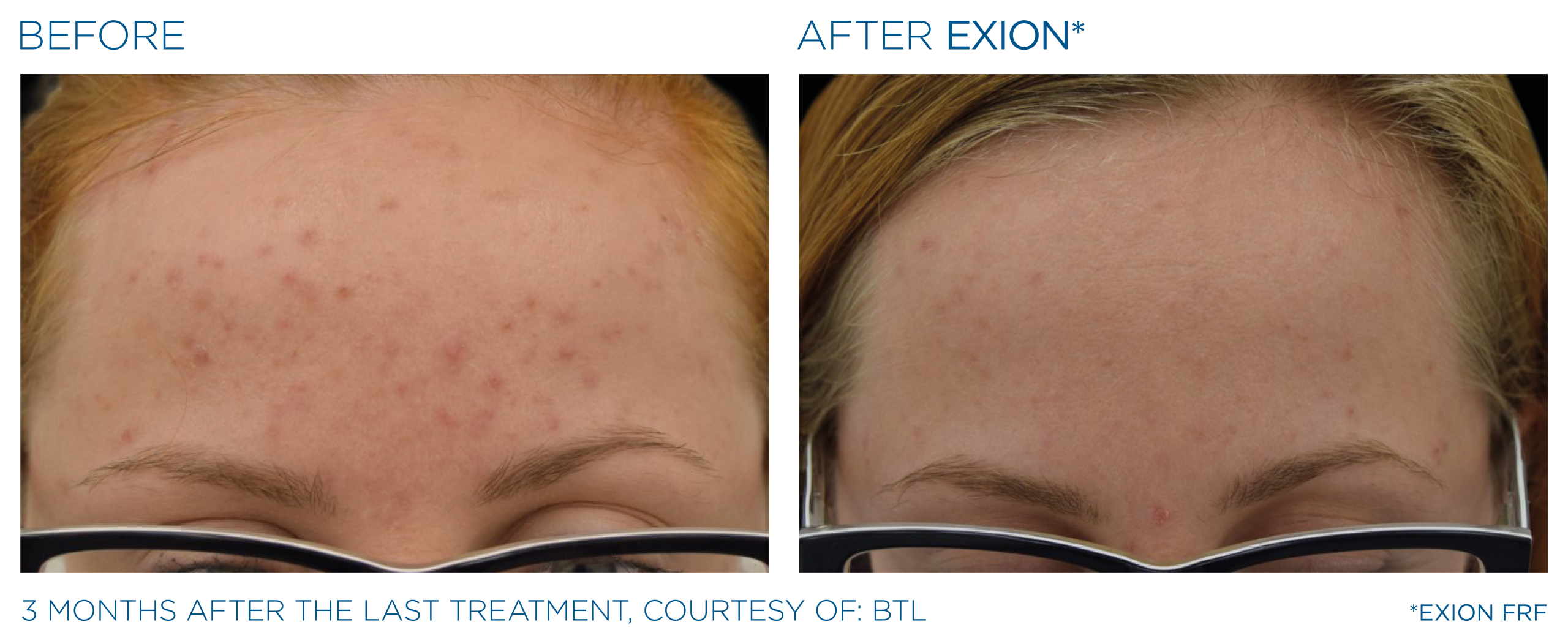 Exion before and after forehead female