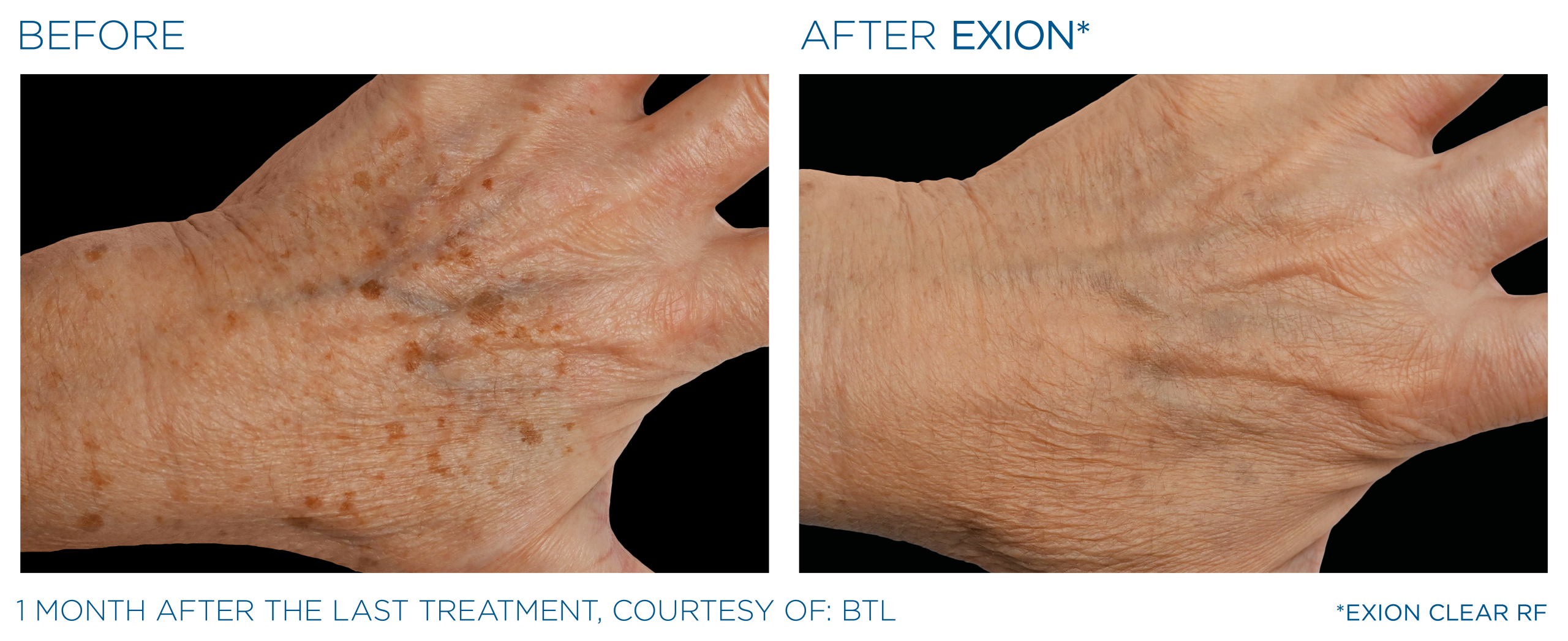 Exion before and after hands