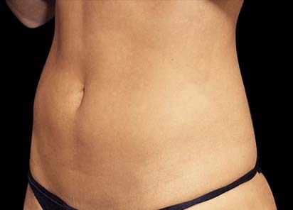 After Emsculpt abs treatment