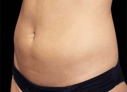 Before Emsculpt abs treatment