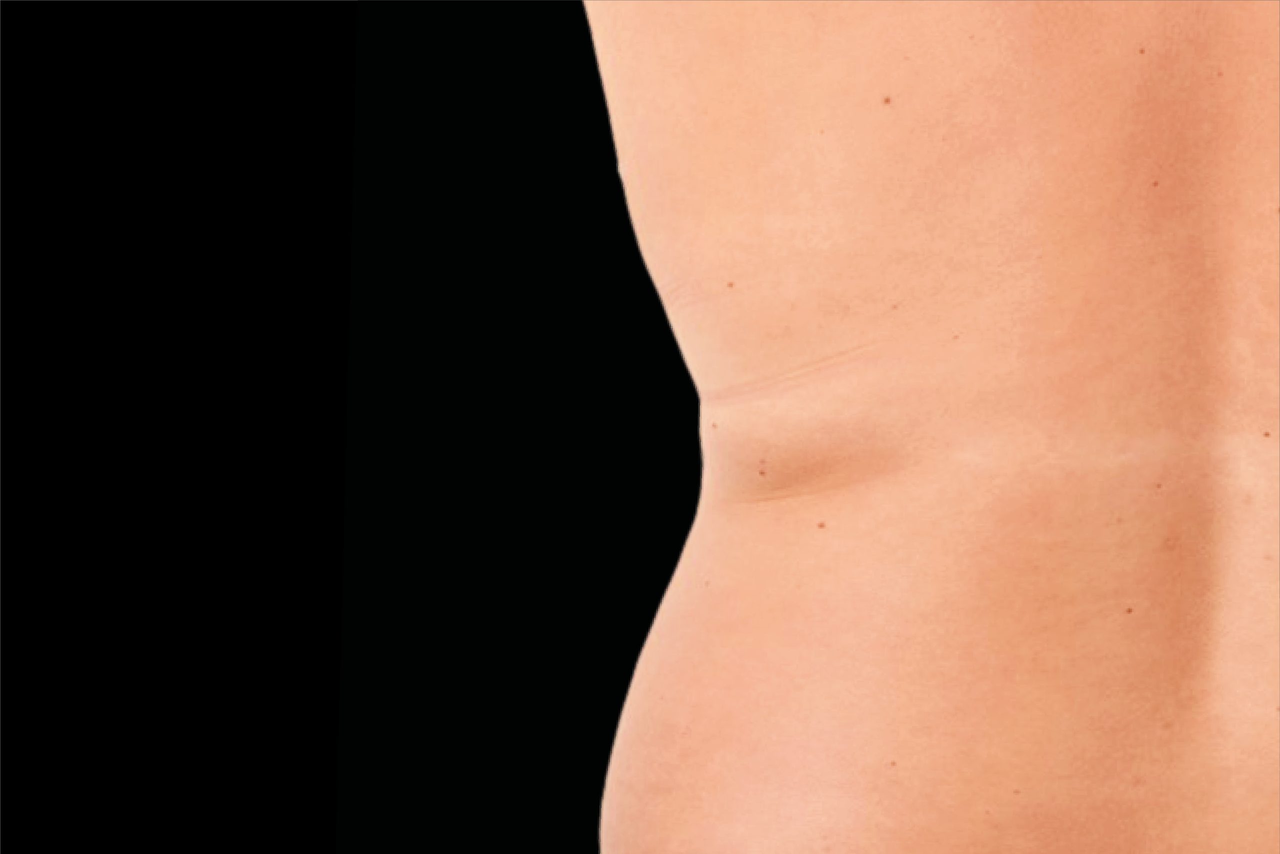 After Exion Body tummy treatment