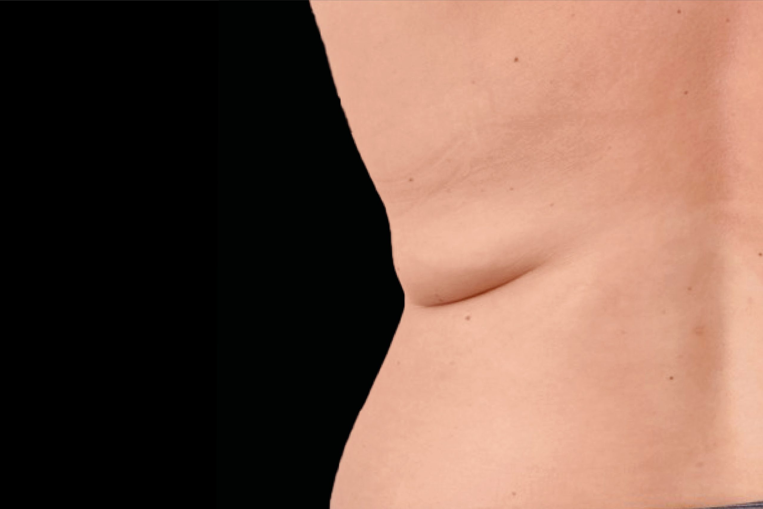Before Exion Body tummy treatment