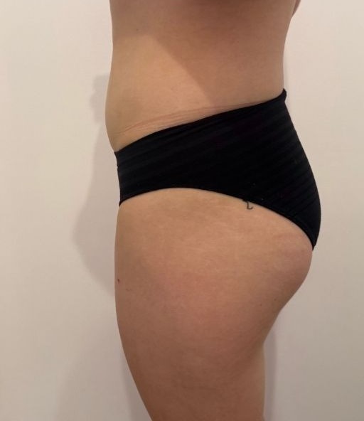 After Emsculpt glutes