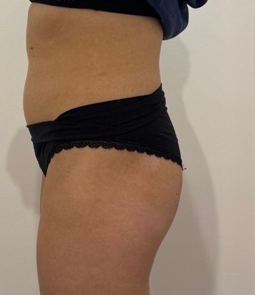 Before Emsculpt glutes